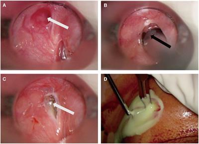 Open surgical excision vs. endoscopic radiofrequency ablation in managing congenital pyriform sinus fistula—a comprehensive analysis of 166 cases